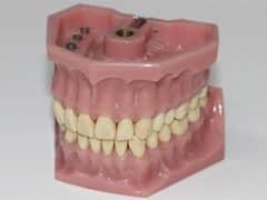 Tandenknarsen gebit